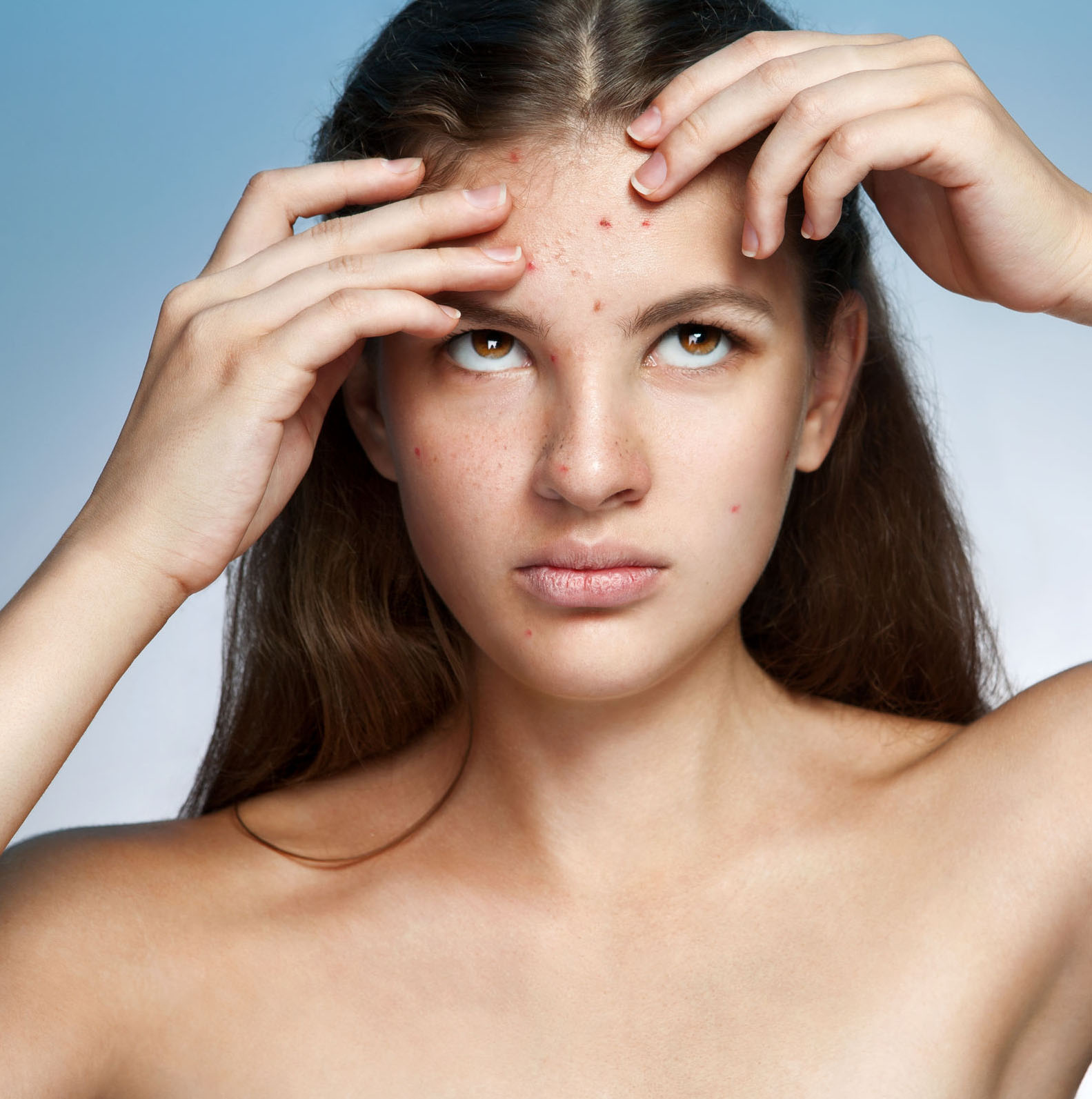 Imagen noticia ACNE MARKS BORRAR LAS MARCAS DE ACNÉ