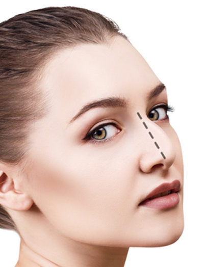 Imagen noticia RINOPLASTIA ULTRASÓNICA: AVANCE CIRUGÍA ESTÉTICA