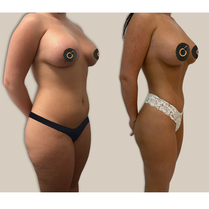 LIPOSCULPT 4D BY BRASÓ: LA REVOLUCIÓN EN CIRUGÍA DE CONTORNO CORPORAL