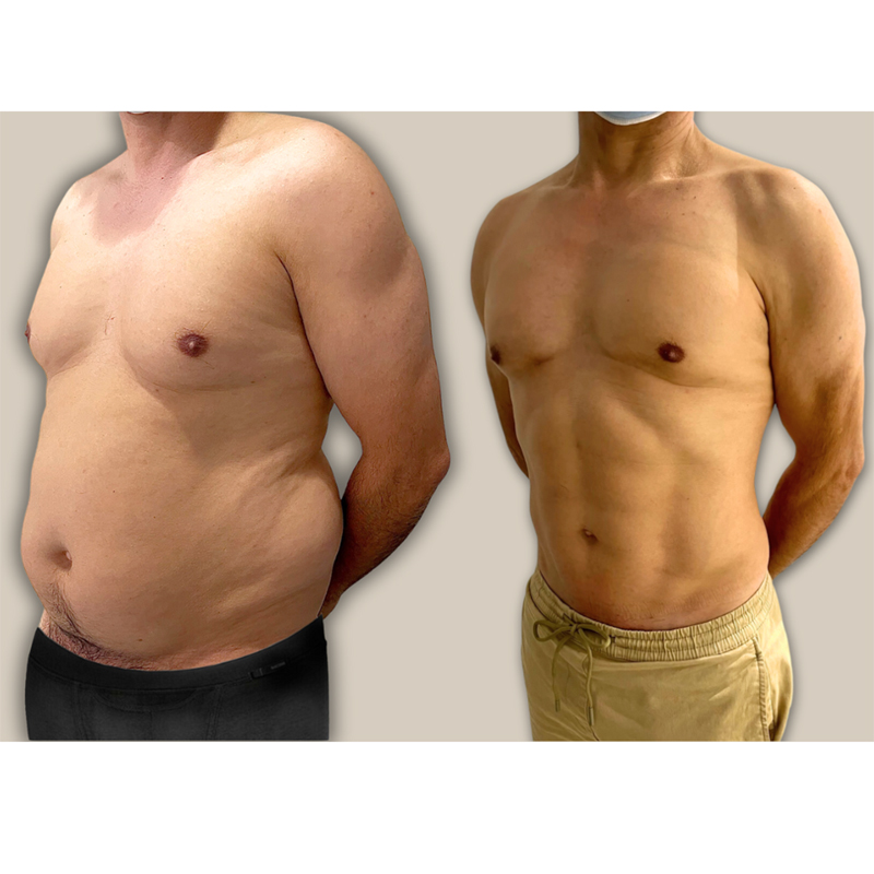 LIPOSCULPT 4D BY BRASÓ: LA REVOLUCIÓN EN CIRUGÍA DE CONTORNO CORPORAL