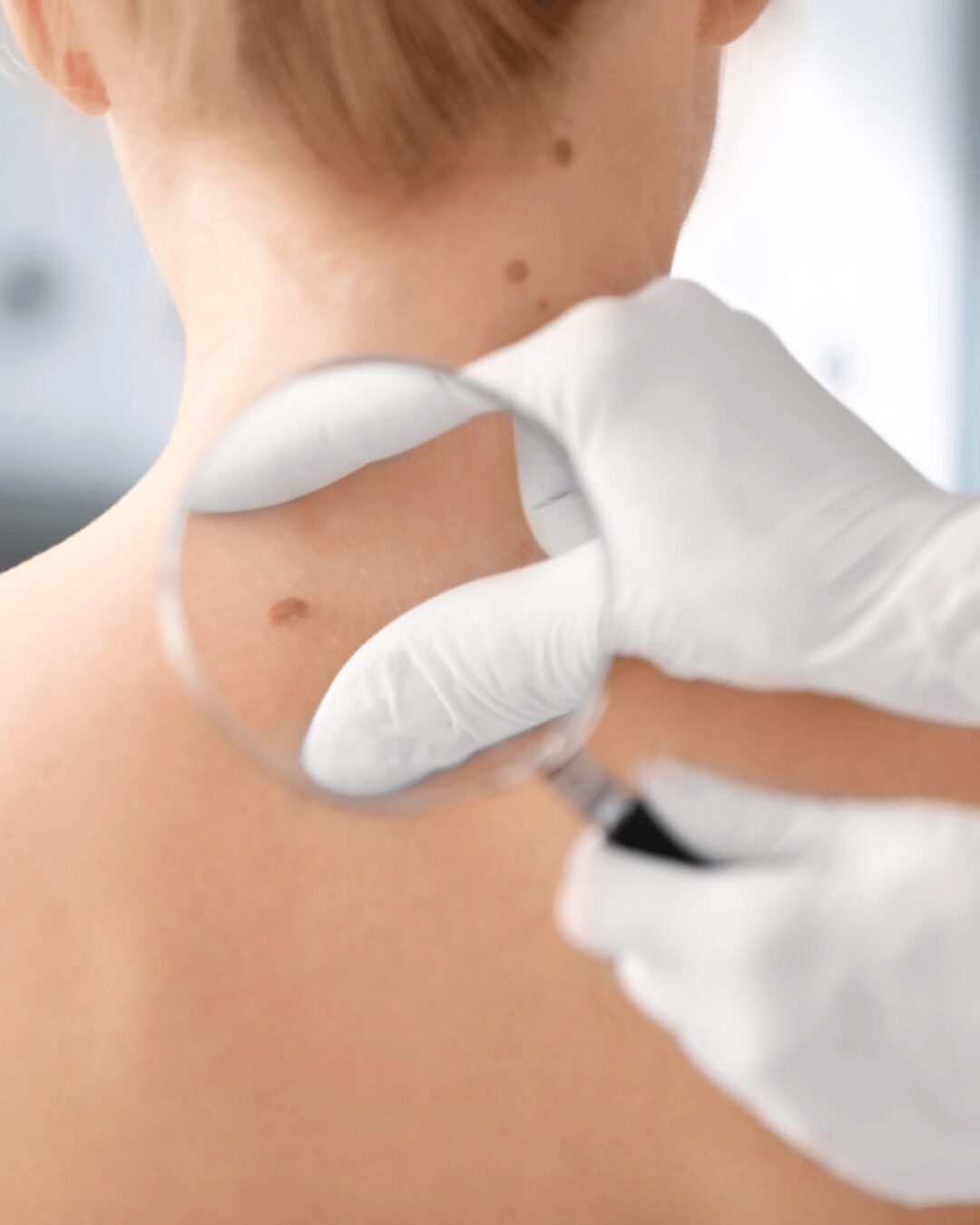 Chica de espaldas y unas manos con lupa analizando sus pecas.