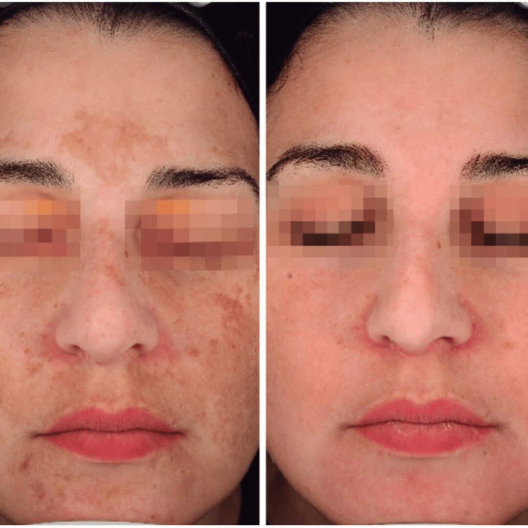 Antes y después del producto de mesoestetic